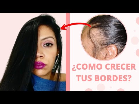 4 consejos para combatir las entradas de calvicie y lucir una cabellera envidiable