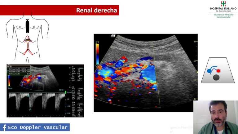 Descubre el sorprendente proceso del doppler renal: ¡todo lo que necesitas saber!